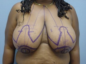 Breast Reduction