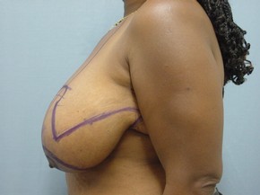 Breast Reduction