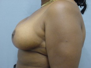 Breast Reduction