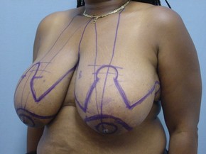 Breast Reduction