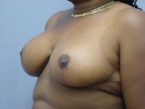 Breast Reduction