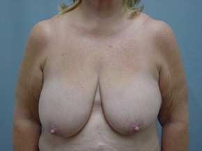 Breast Reduction