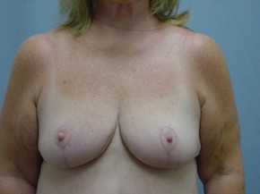Breast Reduction