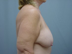 Breast Reduction