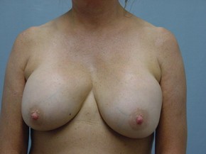 Breast Reduction