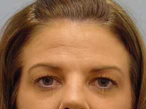 Botox