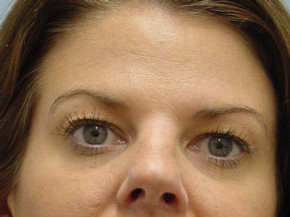 Botox