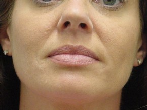 Botox