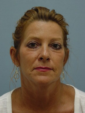 Botox