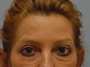 Botox