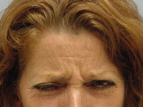 Botox