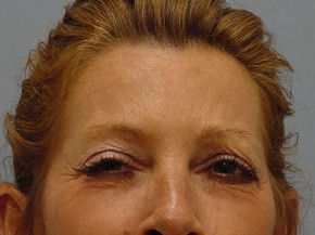 Botox