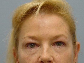 Botox