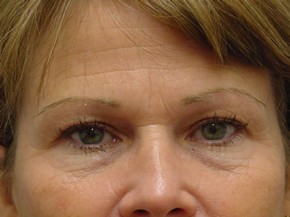 Botox