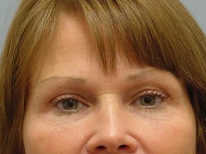 Botox