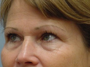 Botox