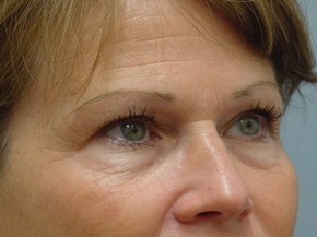 Botox