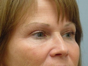 Botox