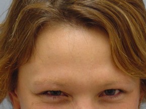 Botox