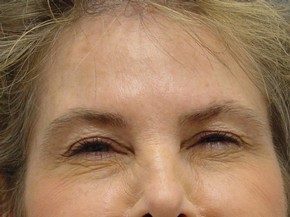 Botox