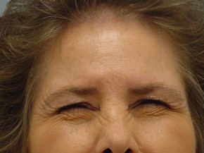 Botox