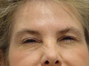 Botox