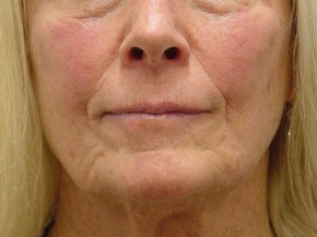 Botox