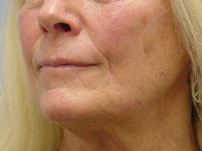 Botox