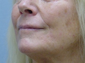 Botox