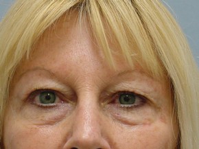 Botox