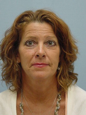 Chemical Brow Lift
