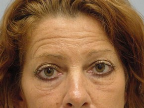 Chemical Brow Lift
