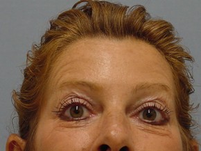 Chemical Brow Lift