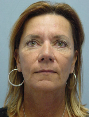 Chemical Brow Lift