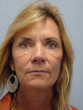 Chemical Brow Lift