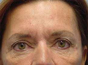 Chemical Brow Lift