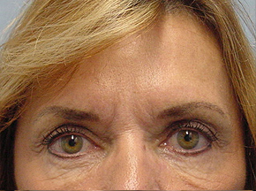 Chemical Brow Lift
