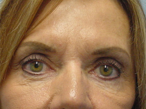 Chemical Brow Lift