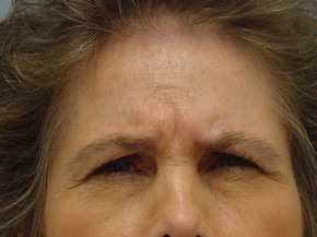 Chemical Brow Lift