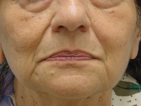 Dermal Fillers