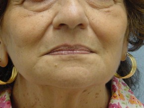 Dermal Fillers