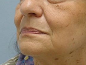 Dermal Fillers