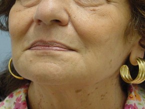 Dermal Fillers