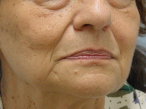 Dermal Fillers