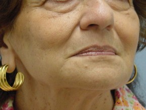Dermal Fillers