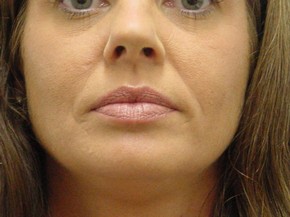 Dermal Fillers