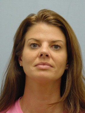 Dermal Fillers