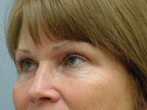 Dermal Fillers