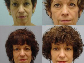 Dermal Fillers