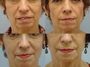 Dermal Fillers
